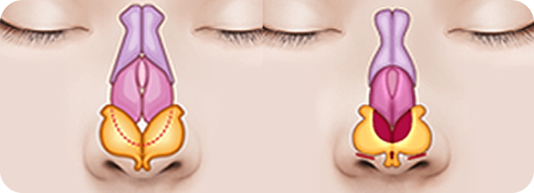 凡是与美 - Rhinoplasty - 自然鼻尖形状