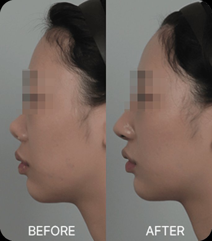 凡是与美 - 鼻部修复 - 因挛缩导致的 contracture