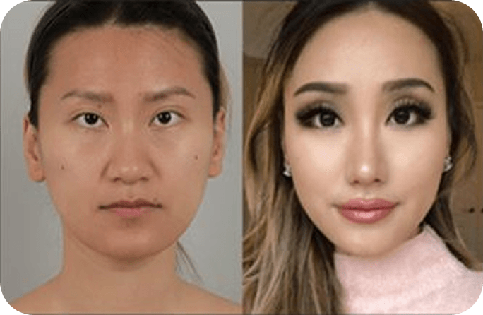 凡是与美 - Asian Rhinoplasty - 术前与术后 1