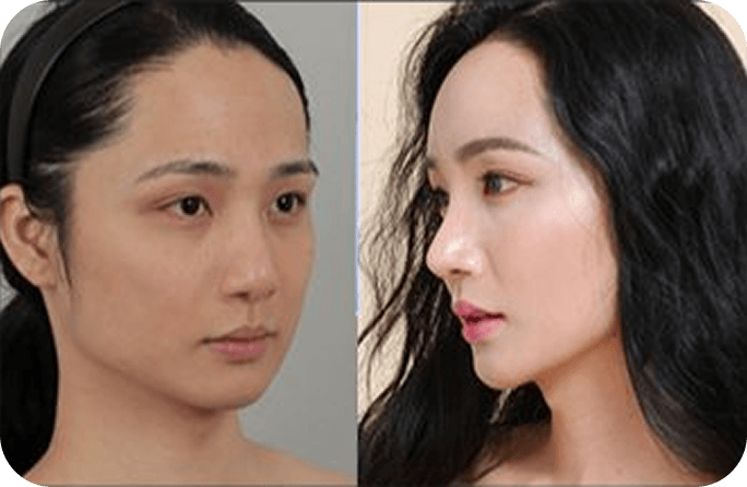 凡是与美 - Asian Rhinoplasty - 术前与术后 2