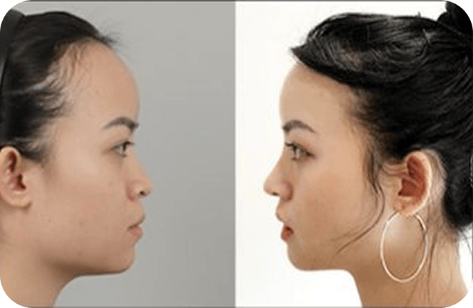 凡是与美 - Asian Rhinoplasty - 术前与术后 3