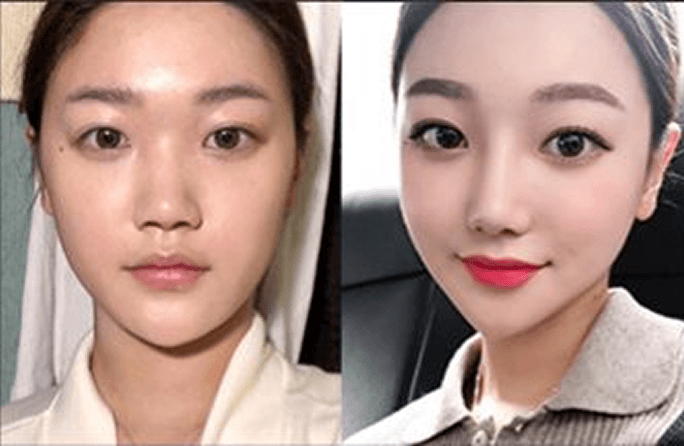 凡是与美 - Asian Rhinoplasty - 术前与术后 4
