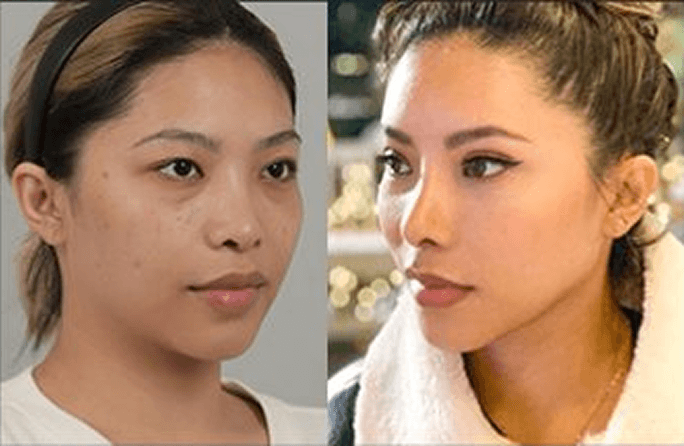 凡是与美 - Asian Rhinoplasty - 术前与术后 5