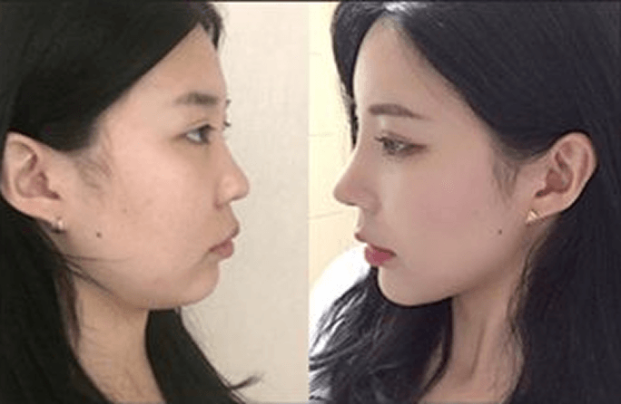 凡是与美 - Asian Rhinoplasty - 术前与术后 6