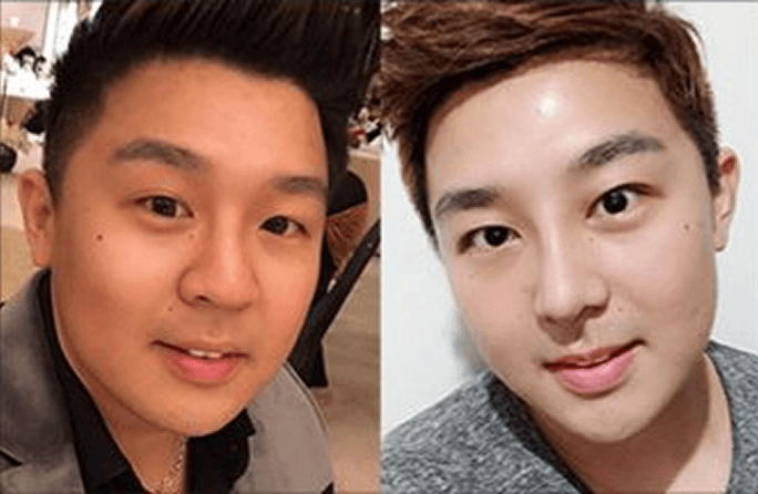 凡是与美 - Asian Rhinoplasty - 术前与术后 7