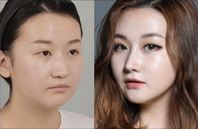 凡是与美 - Asian Rhinoplasty - 术前与术后 8