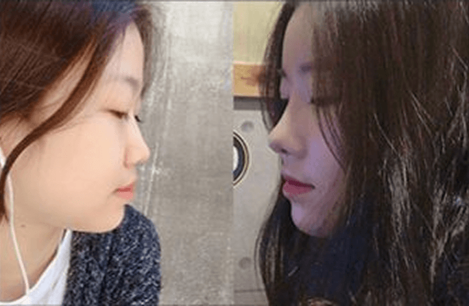 凡是与美 - Asian Rhinoplasty - 术前与术后 9