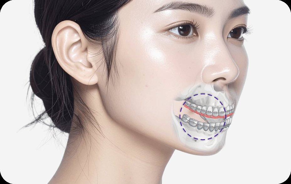 凡是与美 - No-tie 正颌手术 - 凡是与美 No-tie Double Jaw Surgery without Jaw Fixation
