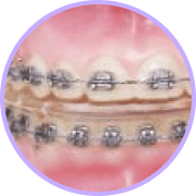 凡是与美 - 手术优先法 正颌手术 - Traditional - Orthodontic treatment 术前时间 1年6个月